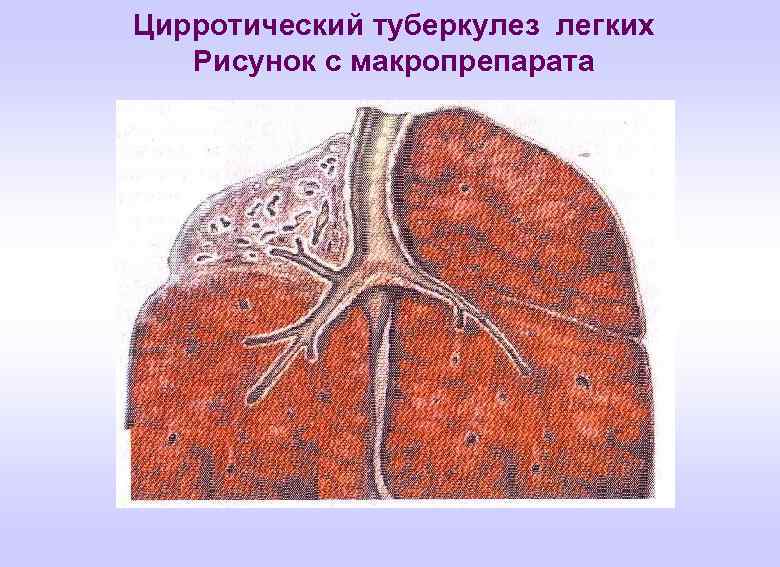Цирротический туберкулез легких Рисунок с макропрепарата 