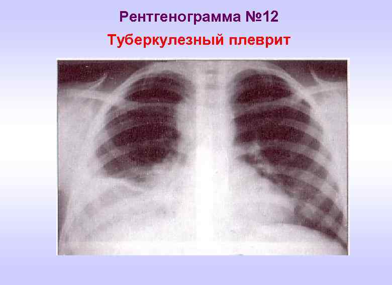 Рентгенограмма № 12 Туберкулезный плеврит 