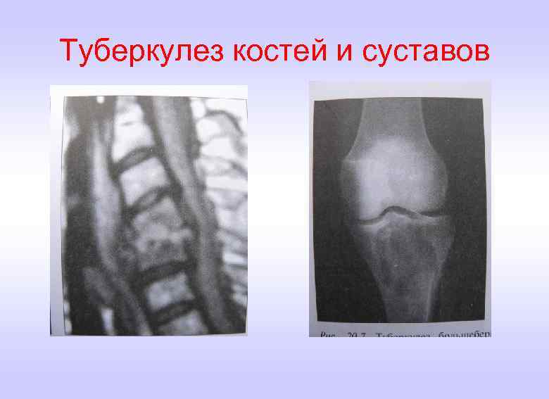 Презентация на тему туберкулез костей и суставов