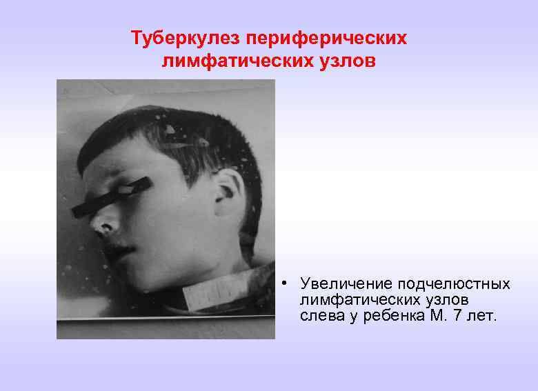 Туберкулез периферических лимфатических узлов • Увеличение подчелюстных лимфатических узлов слева у ребенка М. 7