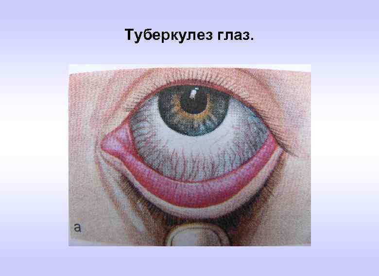 Туберкулез глаз. 