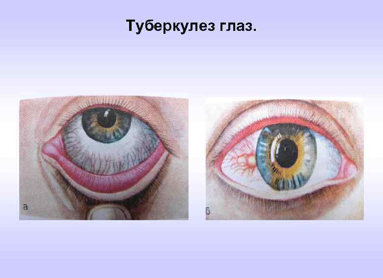 Туберкулез глаз. 
