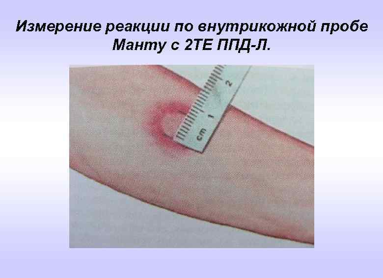 Измерение реакции по внутрикожной пробе Манту с 2 ТЕ ППД-Л. 