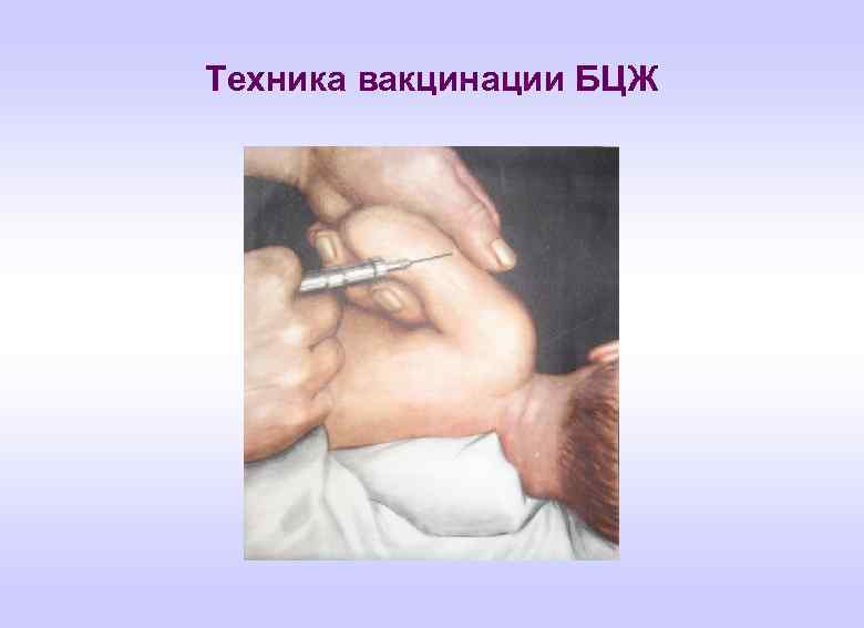Техника вакцинации БЦЖ 