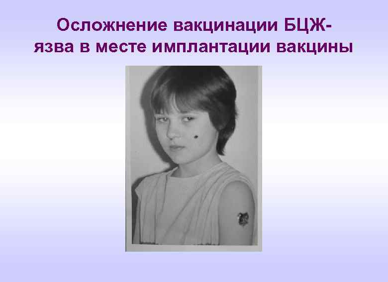 Осложнение вакцинации БЦЖ- язва в месте имплантации вакцины 