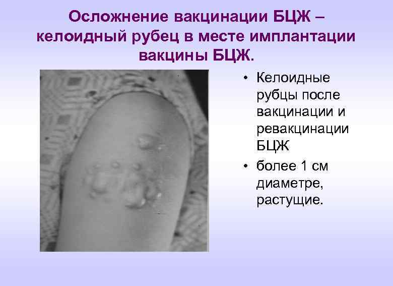 Осложнение вакцинации БЦЖ – келоидный рубец в месте имплантации вакцины БЦЖ. • Келоидные рубцы