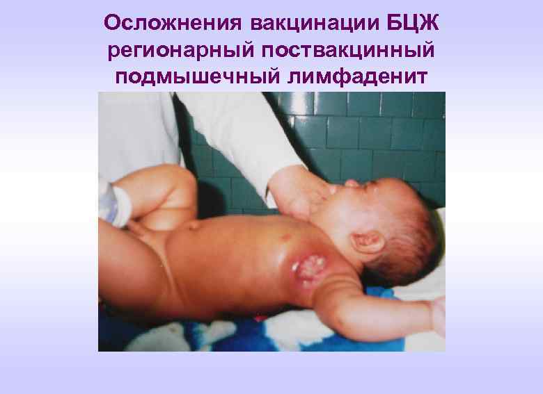 Осложнения вакцинации БЦЖ регионарный поствакцинный подмышечный лимфаденит 