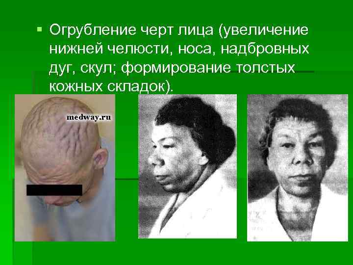 § Огрубление черт лица (увеличение нижней челюсти, носа, надбровных дуг, скул; формирование толстых кожных