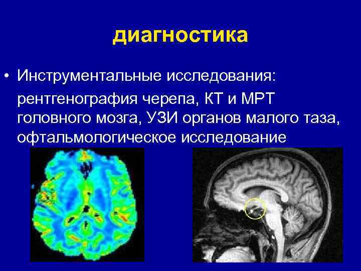 диагностика • Инструментальные исследования: рентгенография черепа, КТ и МРТ головного мозга, УЗИ органов малого