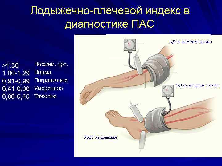 Лодыжечно-плечевой индекс в диагностике ПАС АД на плечевой артери УЗДГ на руке >1, 30