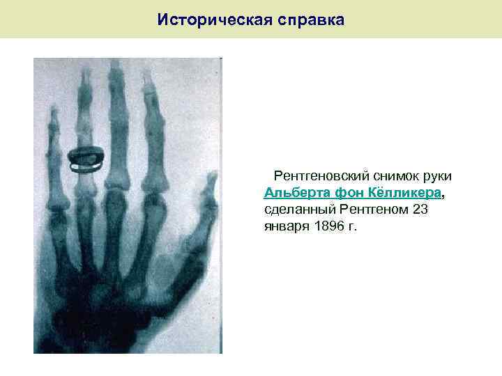 Историческая справка Рентгеновский снимок руки Альберта фон Кёлликера, сделанный Рентгеном 23 января 1896 г.