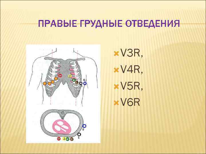 ПРАВЫЕ ГРУДНЫЕ ОТВЕДЕНИЯ V 3 R, V 4 R, V 5 R, V 6