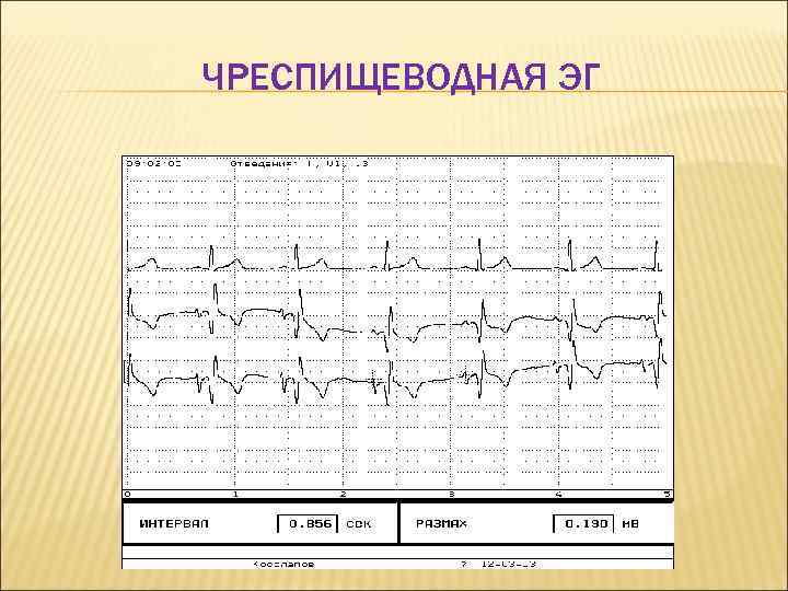 ЧРЕСПИЩЕВОДНАЯ ЭГ 