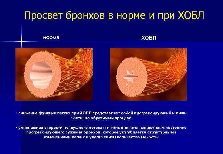 Просвет бронхов в норме и при ХОБЛ норма ХОБЛ • снижение функции легких при