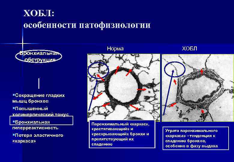 ХОБЛ: особенности патофизиологии Бронхиальная обструкция Норма ХОБЛ §Сокращение гладких мышц бронхов §Повышенный холинергический тонус
