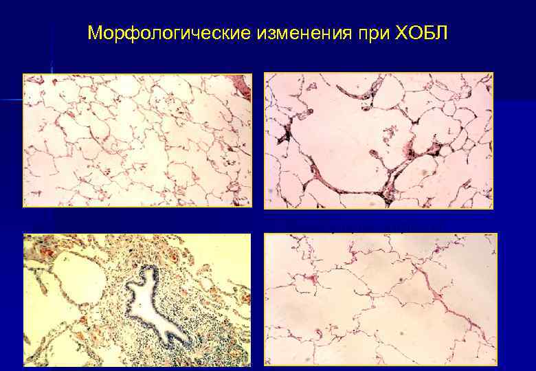 Морфологические изменения при ХОБЛ Нормальная легочная ткань Воспаление бронхиол Центроацинарная эмфизема Панлобулярная эмфизема 