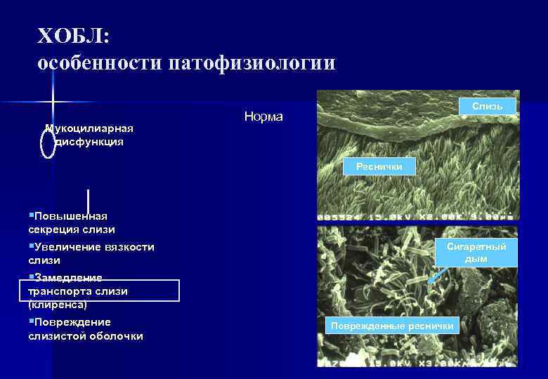ХОБЛ: особенности патофизиологии Мукоцилиарная дисфункция Слизь Норма Реснички §Повышенная секреция слизи §Увеличение вязкости слизи