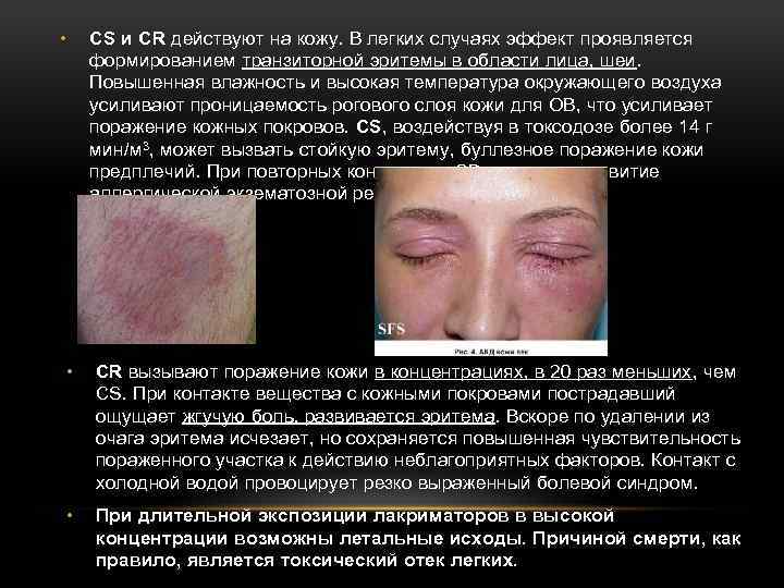  • CS и CR действуют на кожу. В легких случаях эффект проявляется формированием