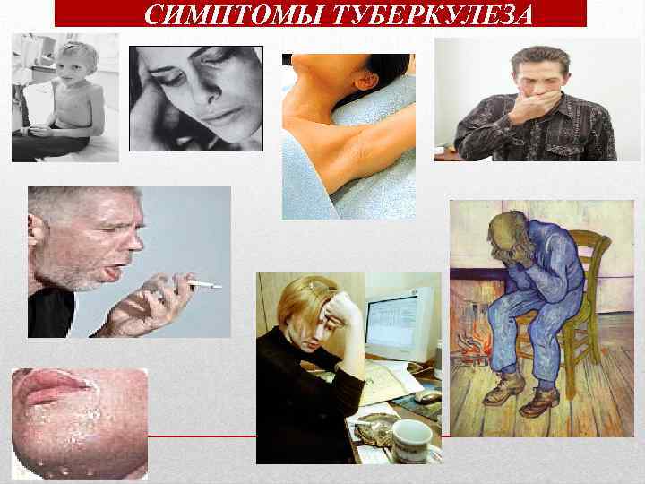 СИМПТОМЫ ТУБЕРКУЛЕЗА 