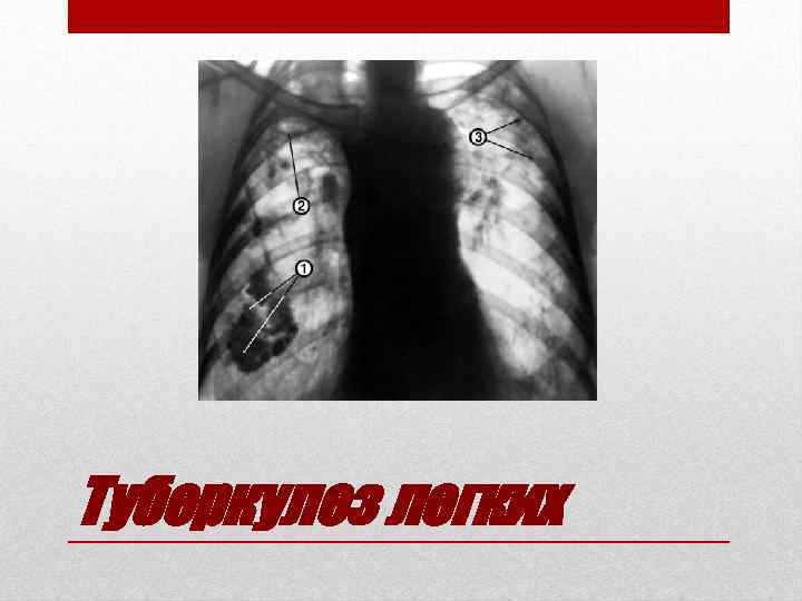 Туберкулез легких 