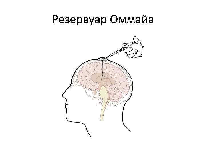 Резервуар Оммайа 