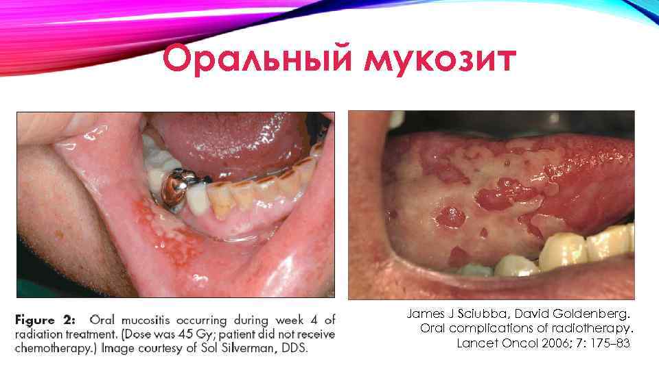 Оральный мукозит James J Sciubba, David Goldenberg. Oral complications of radiotherapy. Lancet Oncol 2006;