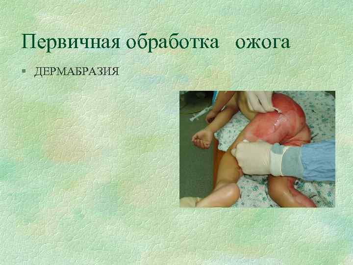 Первичная обработка ожога § ДЕРМАБРАЗИЯ 