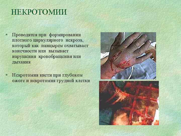 НЕКРОТОМИИ § Проводятся при формировании плотного циркулярного некроза, который как панцырем охватывает конечности или