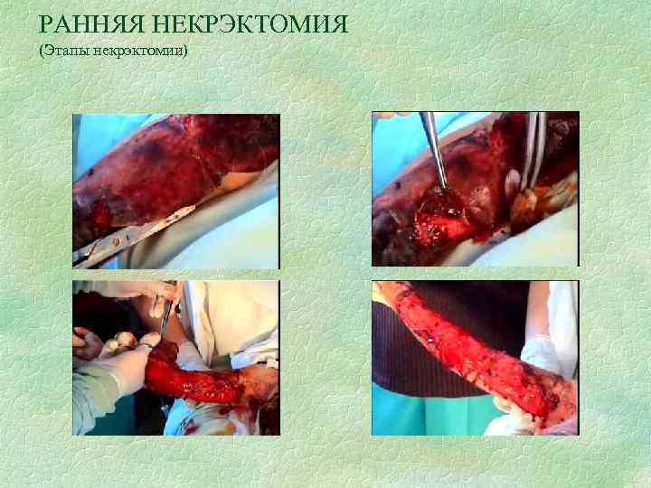 РАННЯЯ НЕКРЭКТОМИЯ (Этапы некрэктомии) 
