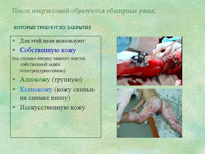 После некрэктомий образуются обширные раны, КОТОРЫЕ ТРЕБУЮТ ИХ ЗАКРЫТИЯ § Для этой цели используют:
