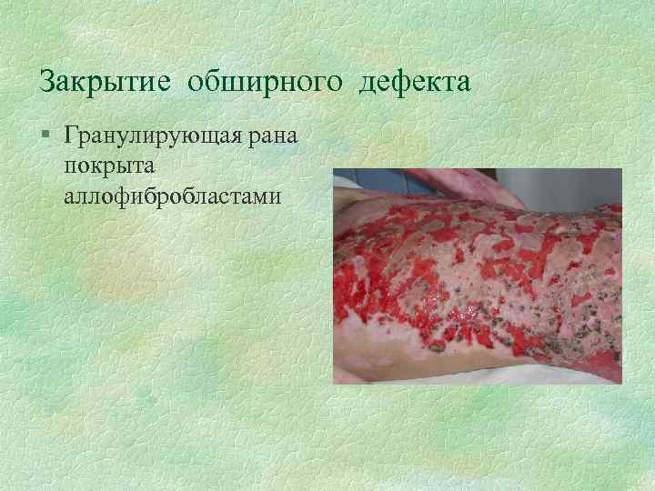 Закрытие обширного дефекта § Гранулирующая рана покрыта аллофибробластами 