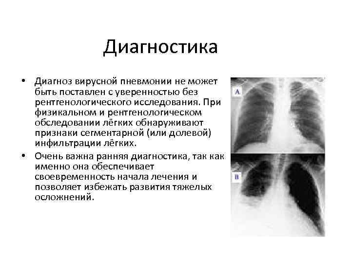 Диагностика • Диагноз вирусной пневмонии не может быть поставлен с уверенностью без рентгенологического исследования.