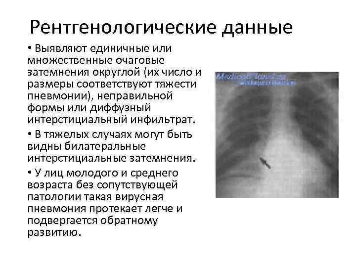 Рентгенологические данные • Выявляют единичные или множественные очаговые затемнения округлой (их число и размеры