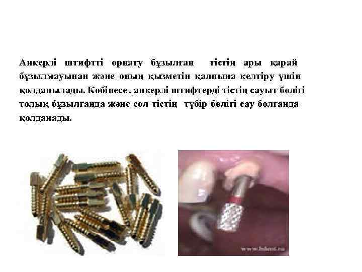 Анкерлі штифтті орнату бұзылған тістің ары қарай бұзылмауынан және оның қызметін қалпына келтіру үшін