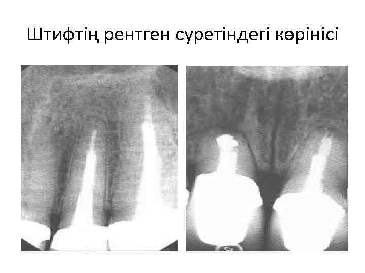 Штифтің рентген суретіндегі көрінісі 