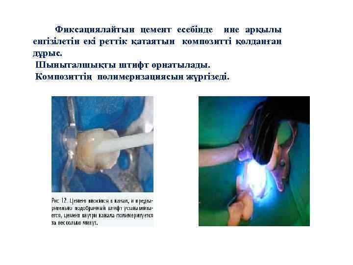 Фиксациялайтын цемент есебінде ине арқылы енгізілетін екі реттік қатаятын композитті қолданған дұрыс. Шыныталшықты штифт
