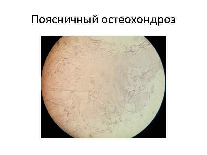 Поясничный остеохондроз 