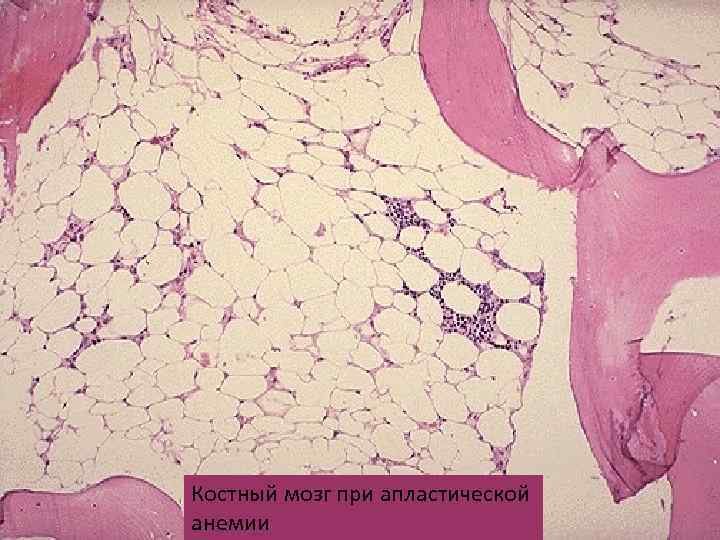 Костный мозг при апластической анемии 