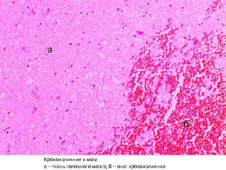 Кровоизлияние в мозг а – ткань головного мозга; б – очаг кровоизлияния 