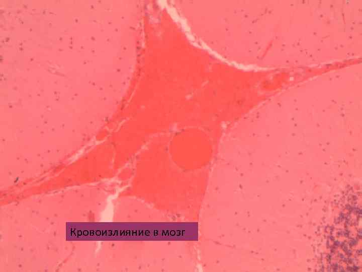 Кровоизлияние в мозг 