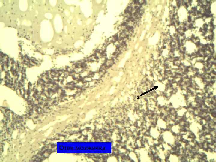 а Отек мозжечка 