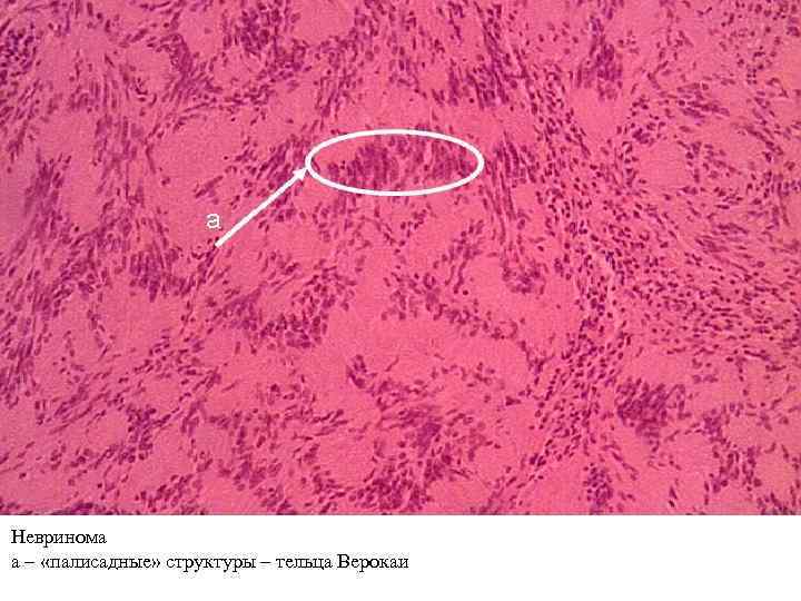 Невринома а – «палисадные» структуры – тельца Верокаи 