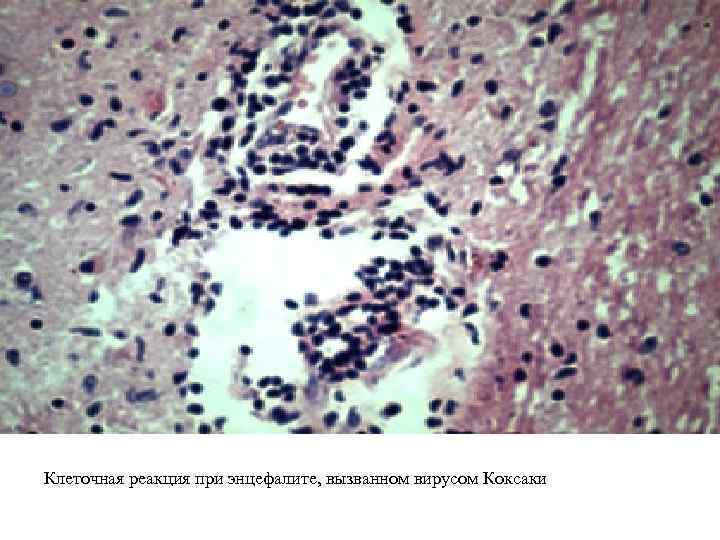 Клеточная реакция при энцефалите, вызванном вирусом Коксаки 
