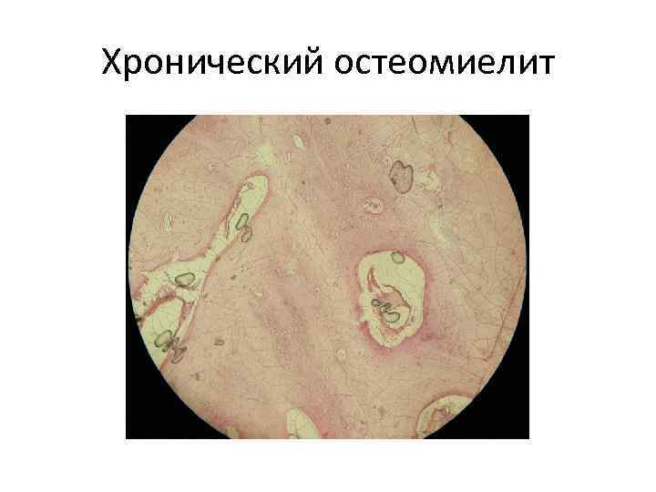 Хронический остеомиелит 