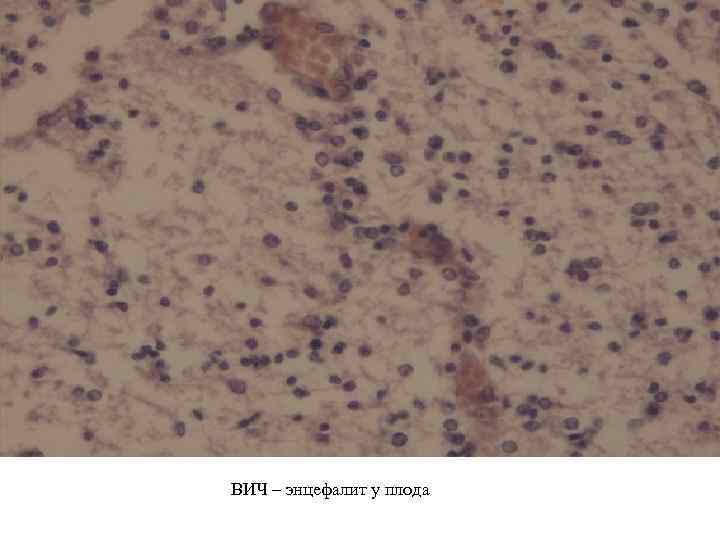ВИЧ – энцефалит у плода 