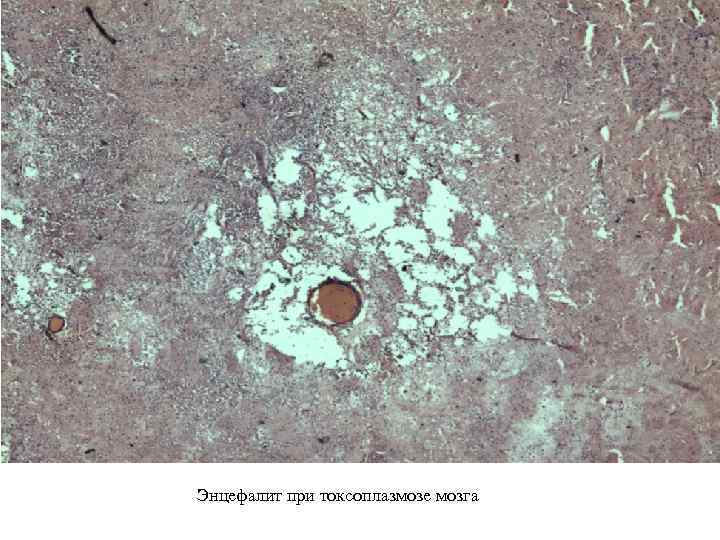 Энцефалит при токсоплазмозе мозга 