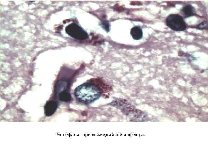 Энцефалит при хламидийной инфекции 
