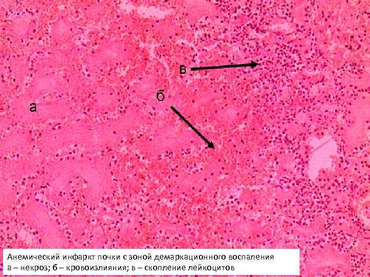 Анемический инфаркт почки с зоной демаркационного воспаления а – некроз; б – кровоизлияния; в