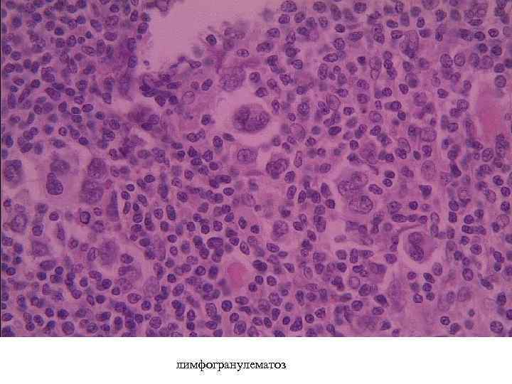 лимфогранулематоз 