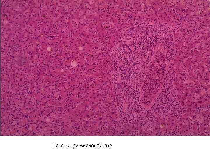 Печень при миелолейкозе 